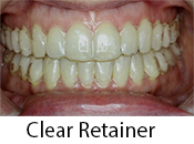 Clear Retainers in Morganville